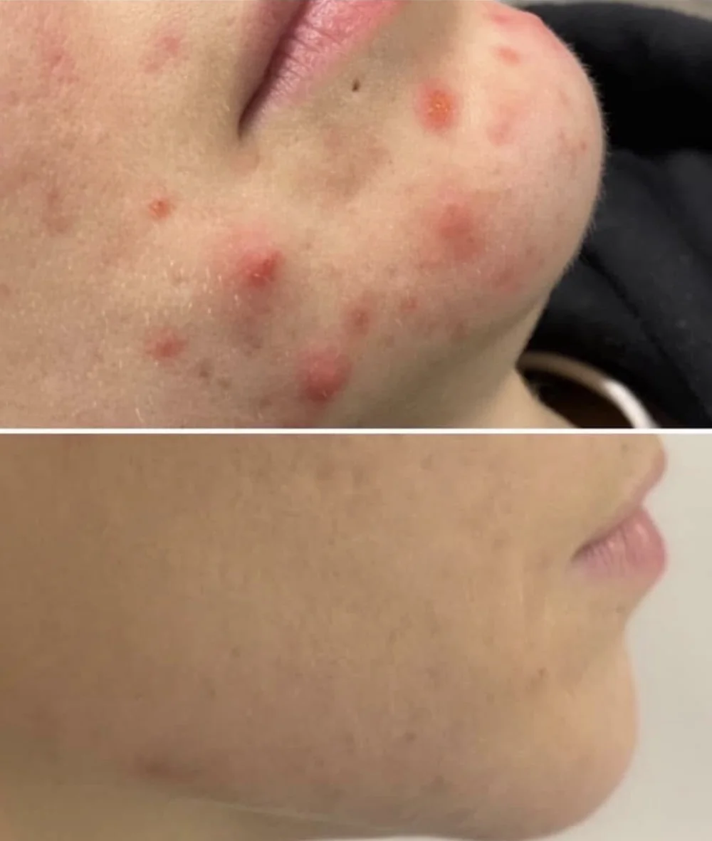 Före och efter aknebehandling med laser: kind och käke i profil