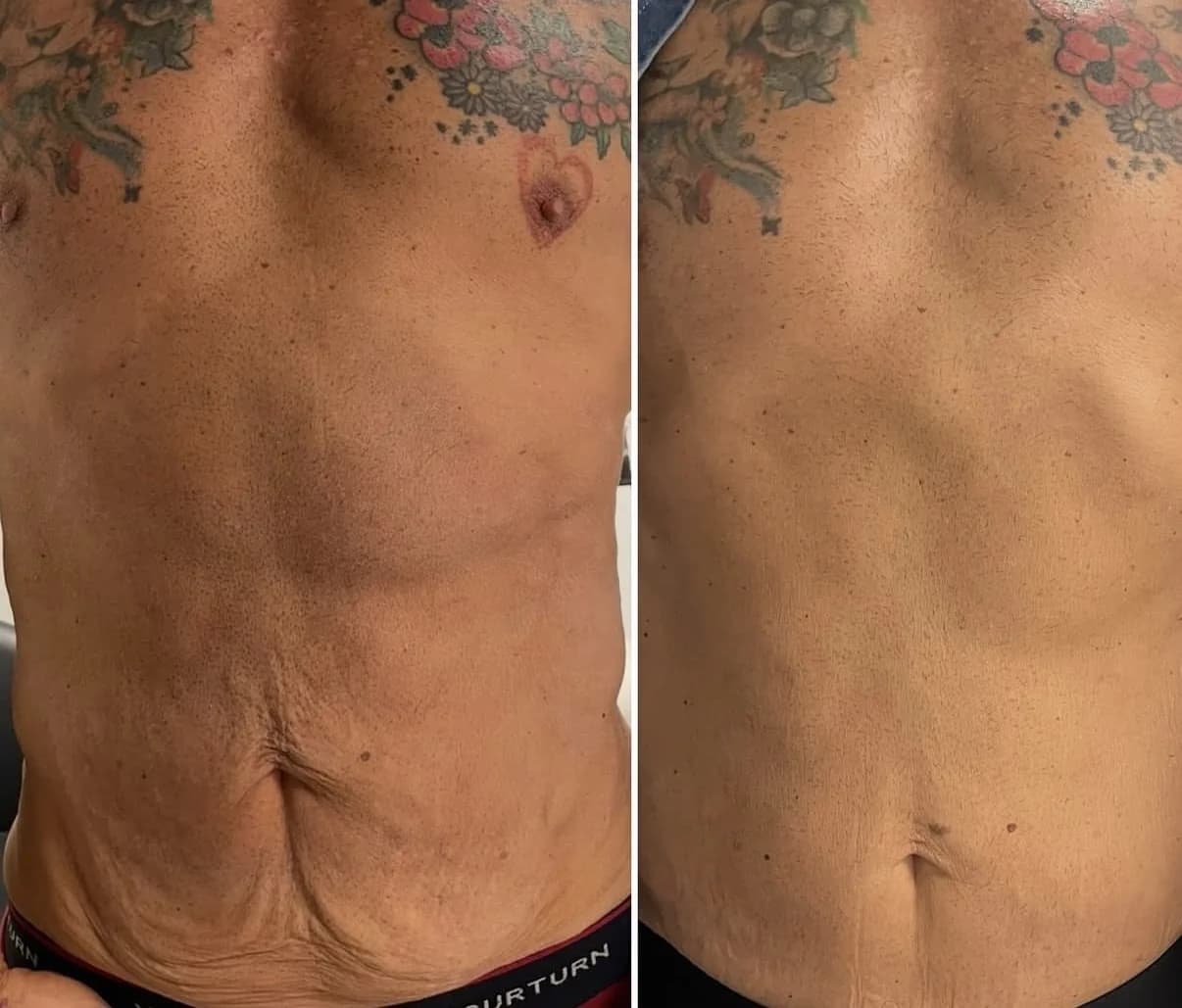Före och efter Icoone: mage framifrån